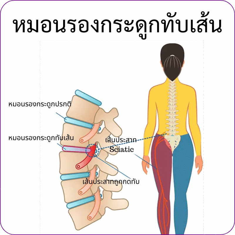 หมอนรองกระดูกทับเส้น กระดูกทับเส้น ปวดหลัง ปวดเอว ปวดสะโพก ปวดร้าวลงขา ขาชา ขาอ่อนแรง